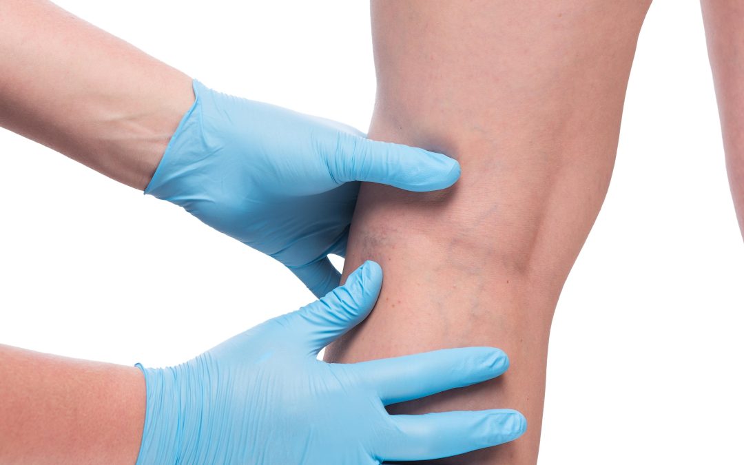 Experience Lasting Relief from Leg Pain with a Skilled Vein Specialist in Petersburg, VA