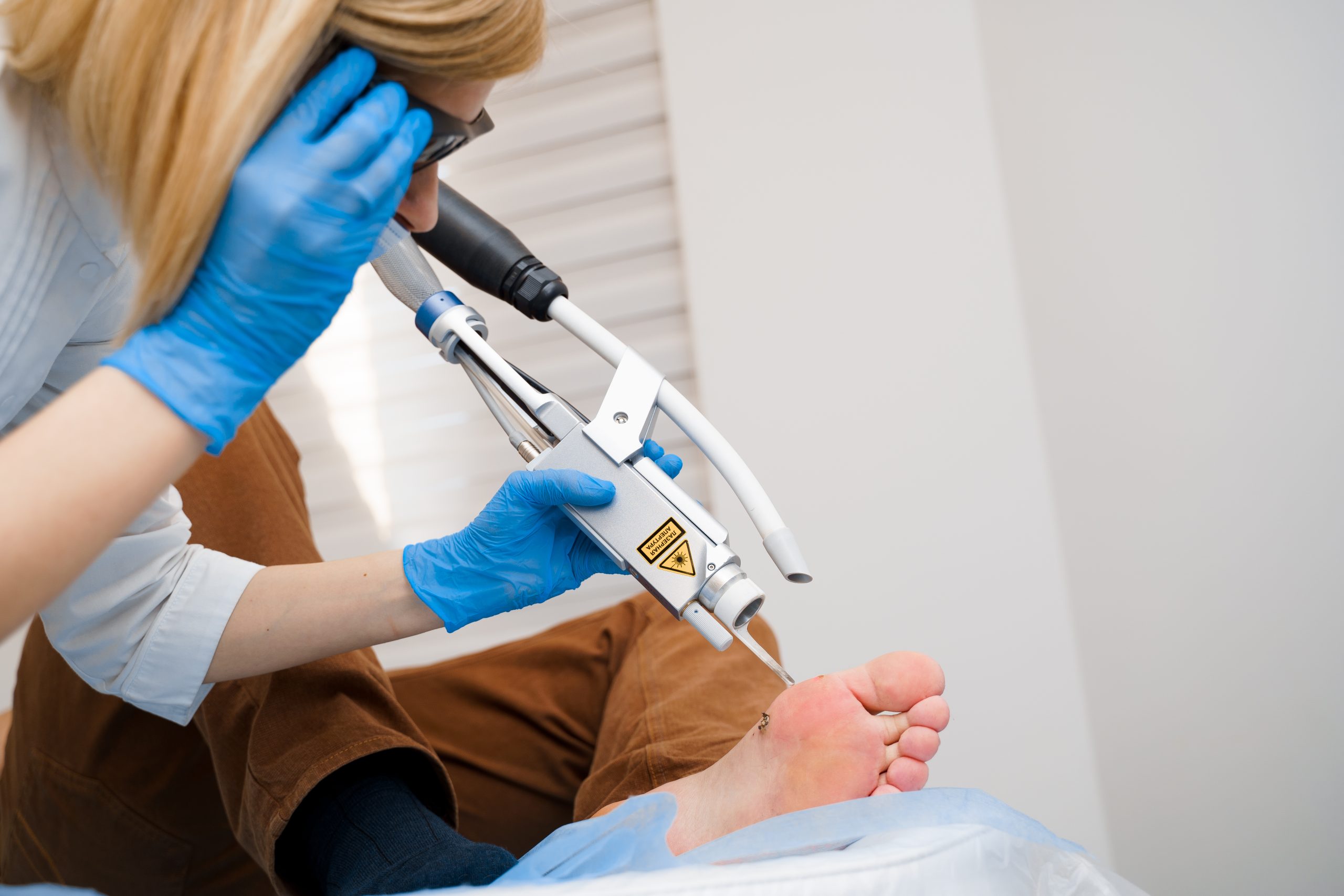 Laser removal of warts on the foot. Medical dermatological surgery in the clinic.
